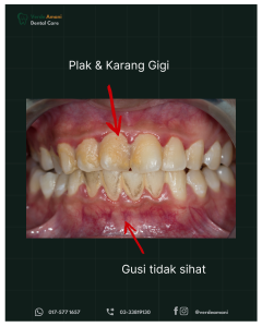 Scaling Gigi Murah Shah Alam