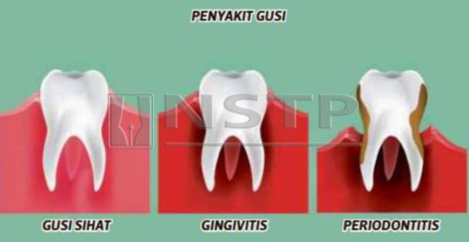 harga cabut gigi di klinik swasta