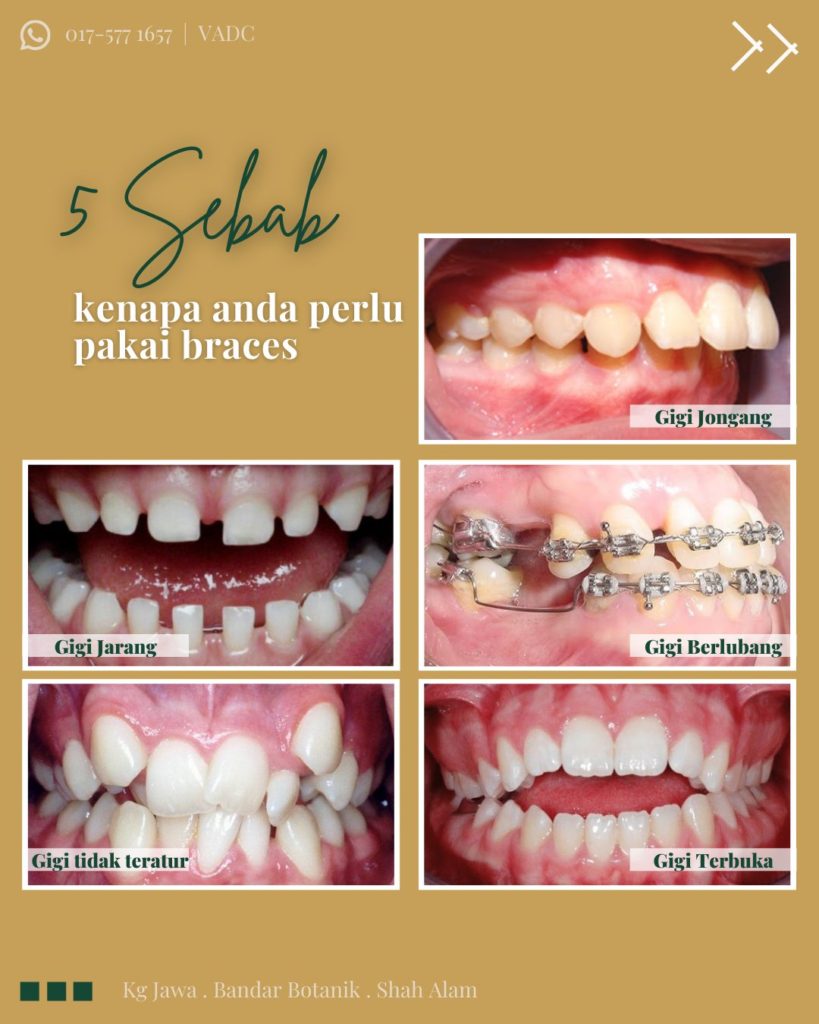 klinik pasang braces murah