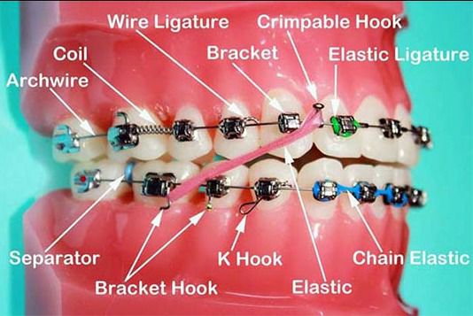 Kesan Getah Braces Tercabut